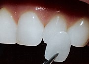 Реставрация зубов